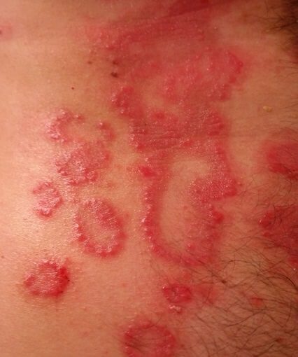 skin rash