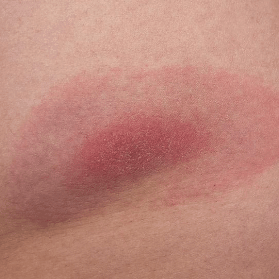 bullseye rash tick bite lyme disease