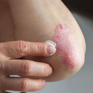 Psoriasis Elbow